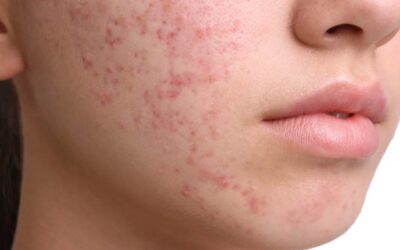 Terapia biofotonica Kleresca: una nuova frontiera per la salute della pelle