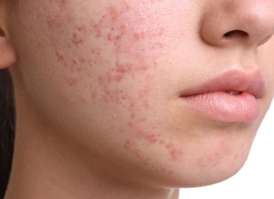Trattamento dermatologico per acne e cicatrici.